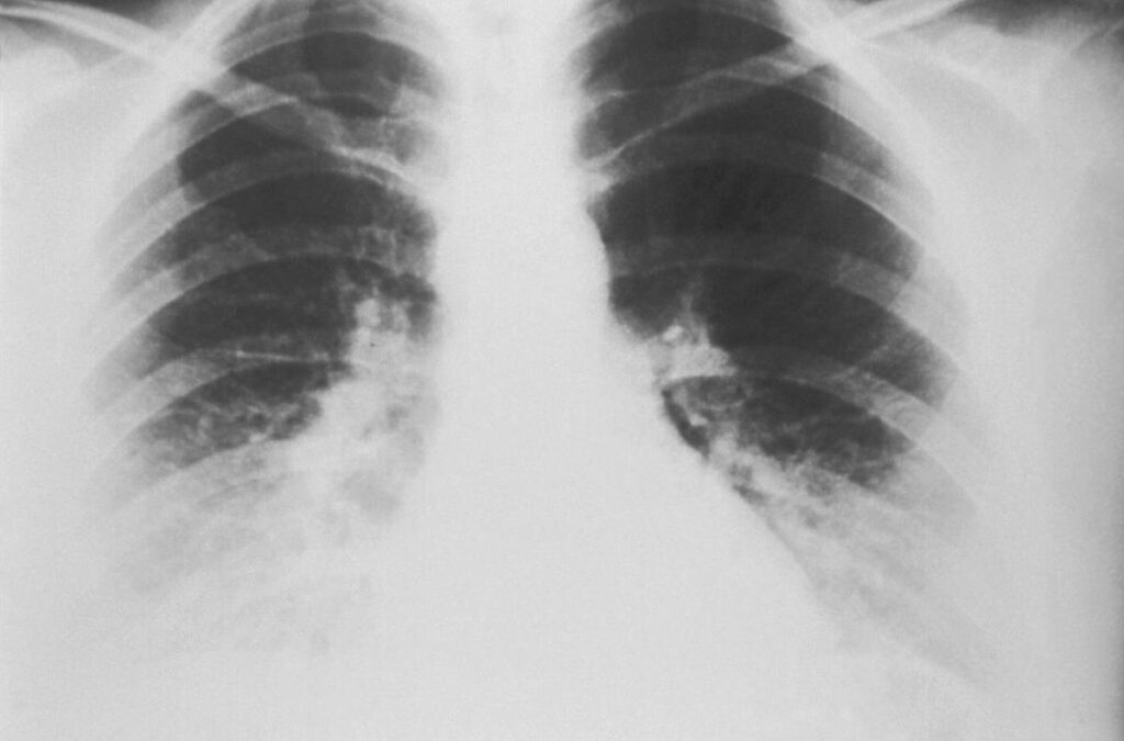 Lung Detox Technique: 7 Proven Ways to Avoid Painful Breathing Mistakes