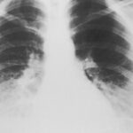 Lung Detox Technique: 7 Proven Ways to Avoid Painful Breathing Mistakes